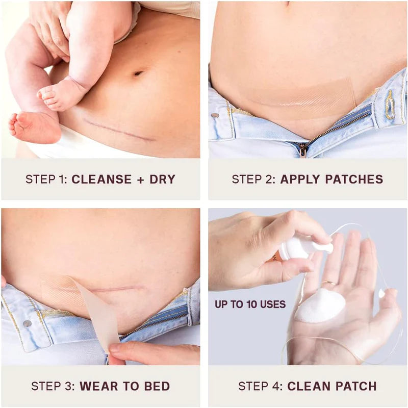 DERMACLARA | C-Section Scar Occlusion Patch